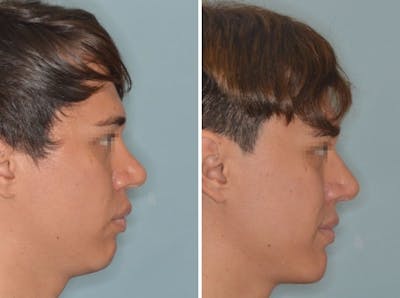Revision Rhinoplasty before and after, lateral right.