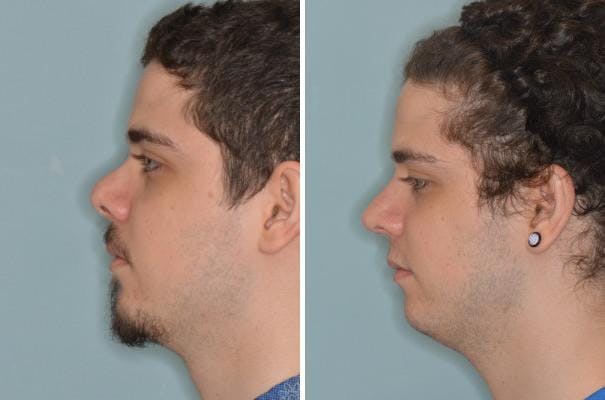 Revision Rhinoplasty before and after, lateral left.