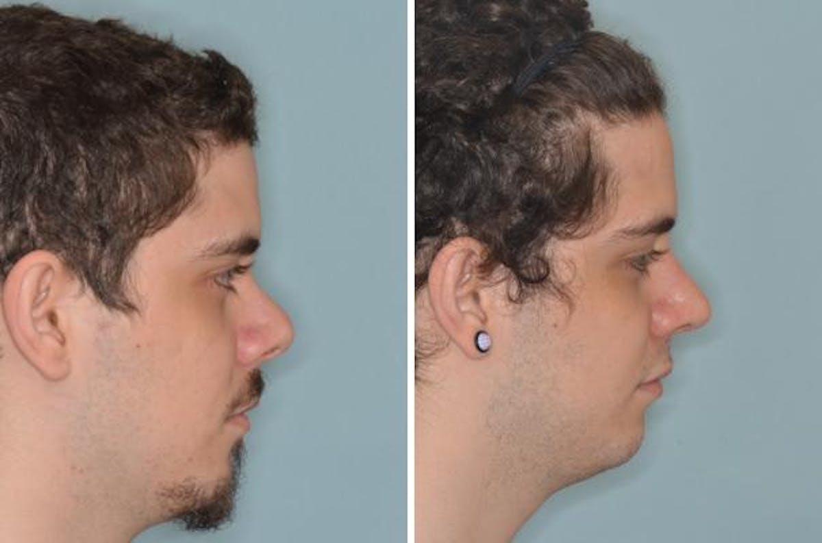 Revision Rhinoplasty before and after, lateral right.
