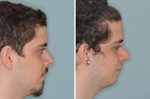 Revision Rhinoplasty before and after, lateral right.