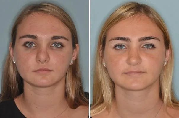 Revision Rhinoplasty before and after, frontal.