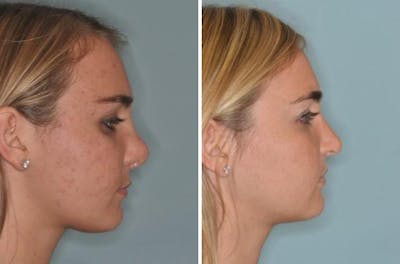 Revision Rhinoplasty before and after, lateral right.