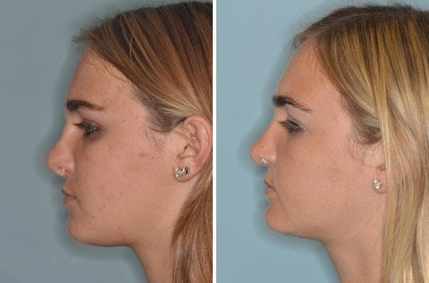 Revision Rhinoplasty before and after, lateral left.