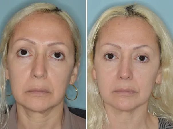 Revision Rhinoplasty before and after, frontal.