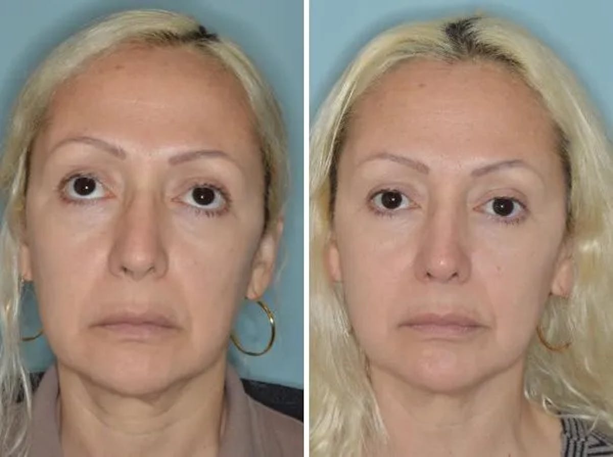 Revision Rhinoplasty before and after, frontal.