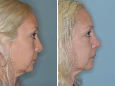 Revision Rhinoplasty before and after, lateral right.