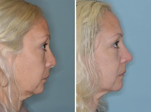 Revision Rhinoplasty before and after, lateral right.