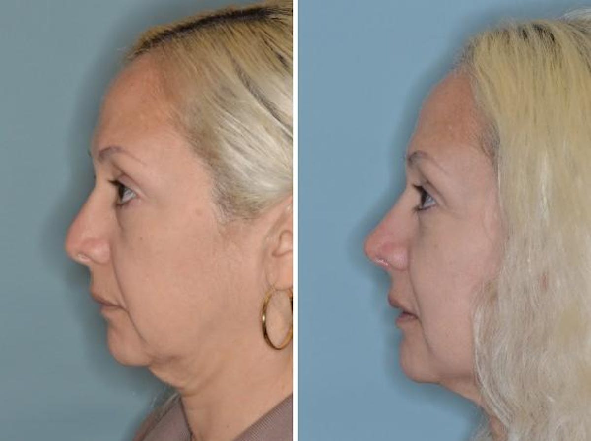 Revision Rhinoplasty before and after, lateral left.