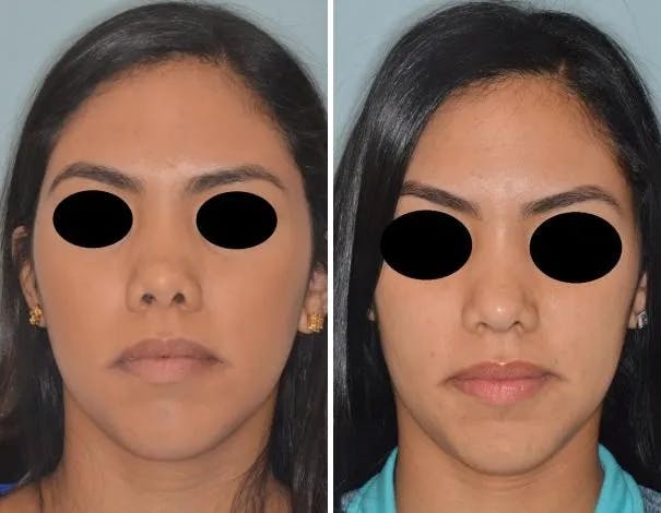 Revision Rhinoplasty before and after, frontal.