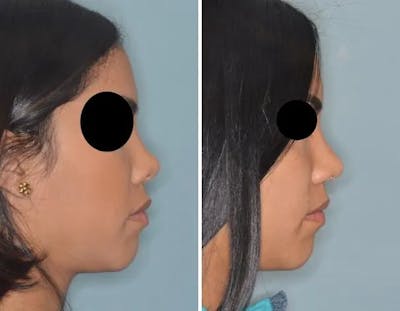 Revision Rhinoplasty before and after, lateral right.
