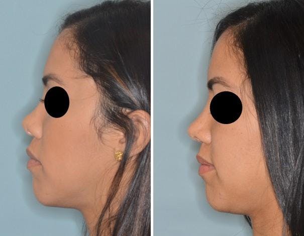 Revision Rhinoplasty before and after, lateral left.