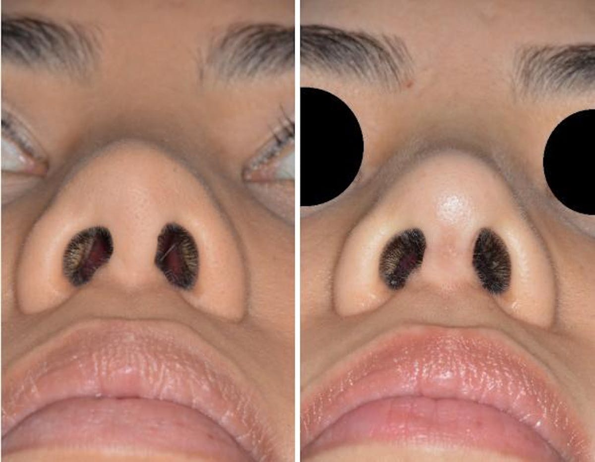 Revision Rhinoplasty before and after, frontal.