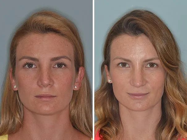 Revision Rhinoplasty before and after, frontal.