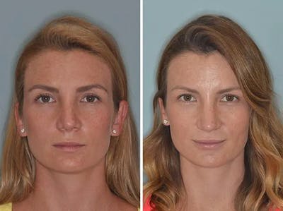 Revision Rhinoplasty before and after, frontal.