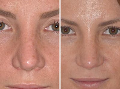 Revision Rhinoplasty before and after, frontal.