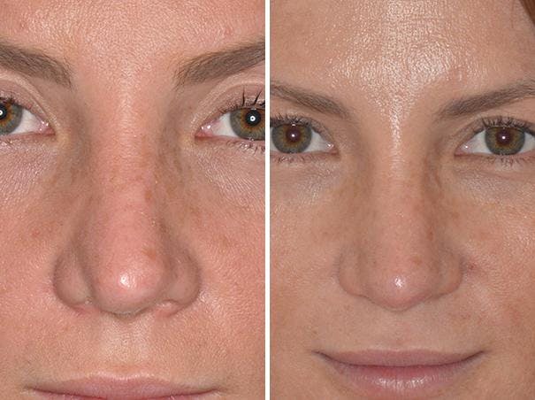 Revision Rhinoplasty before and after, frontal.