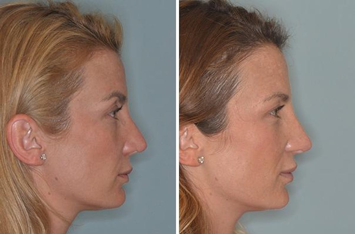 Revision Rhinoplasty before and after, lateral right.