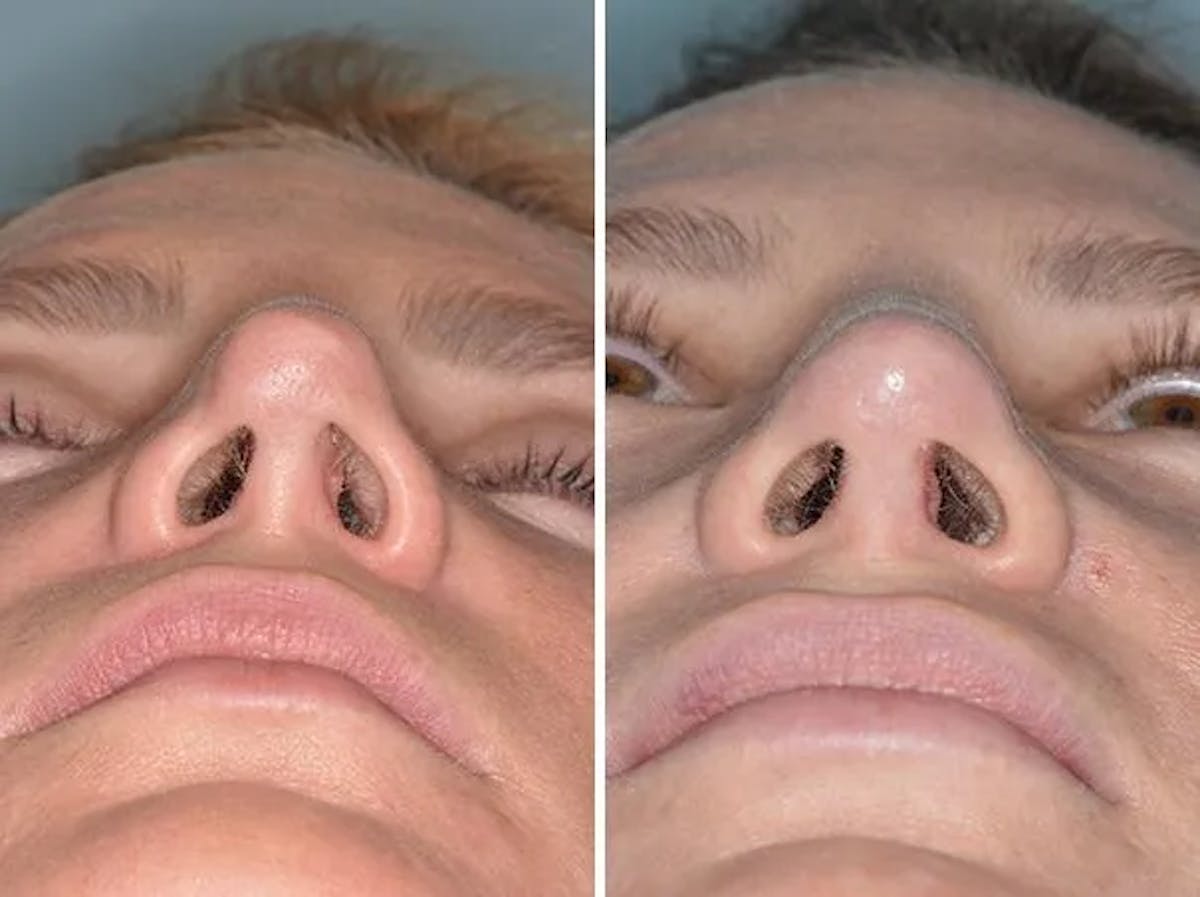 Revision Rhinoplasty before and after, frontal.