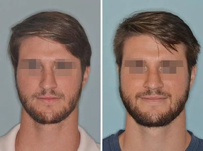 Revision Rhinoplasty before and after, frontal.