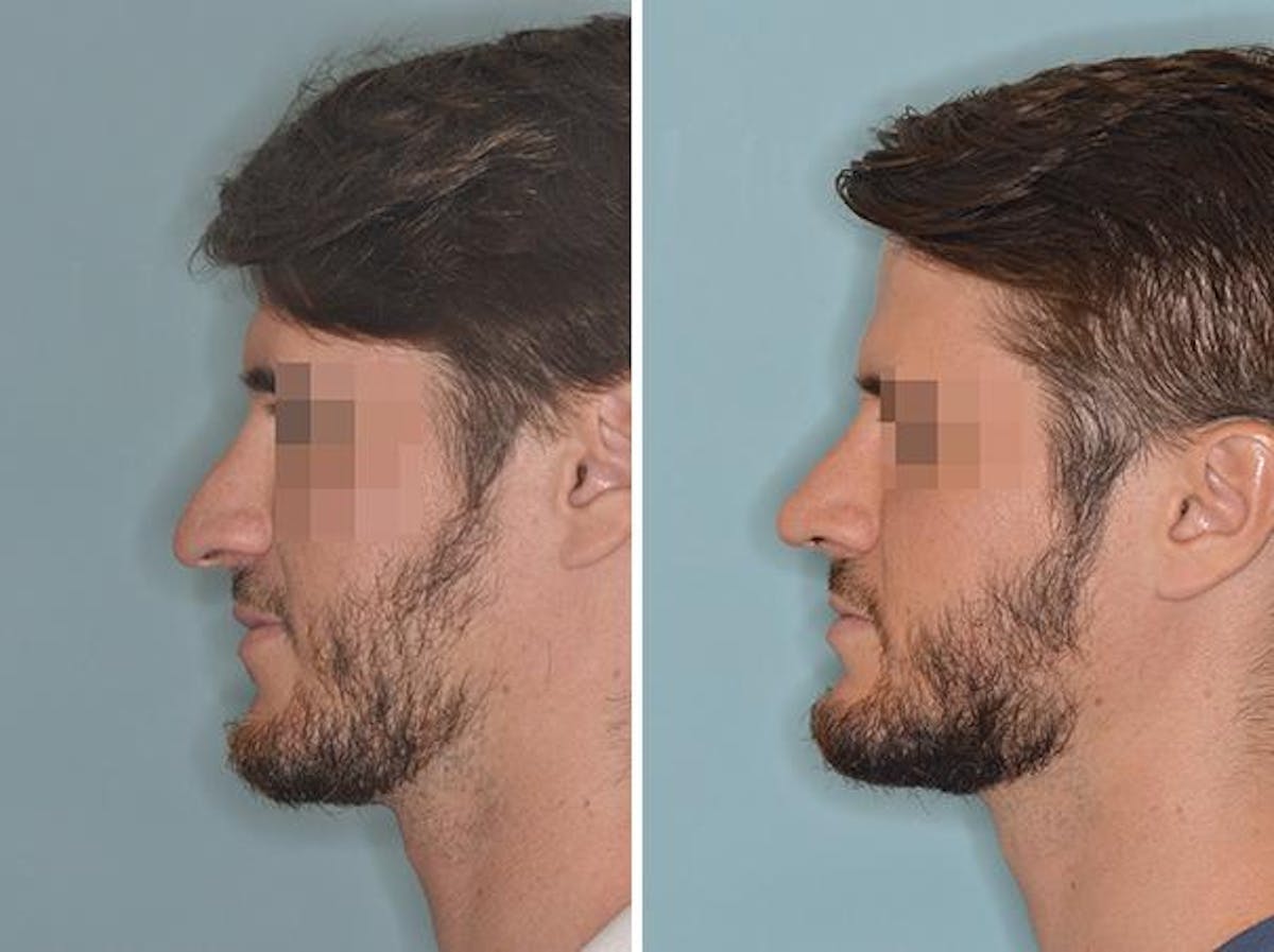 Revision Rhinoplasty before and after, lateral left.