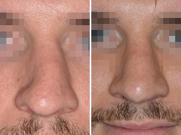 Revision Rhinoplasty before and after, frontal.