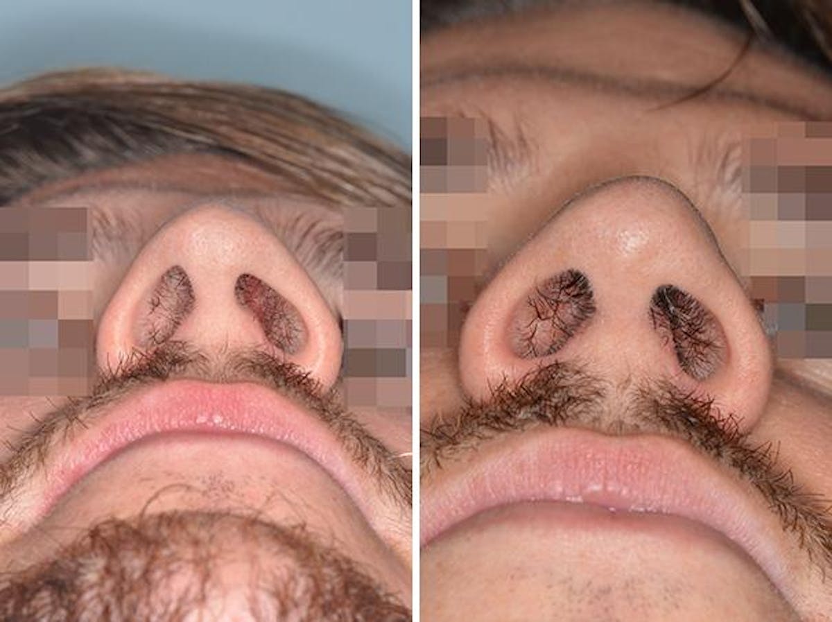 Revision Rhinoplasty before and after, frontal.