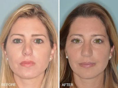 Revision Rhinoplasty before and after, frontal.