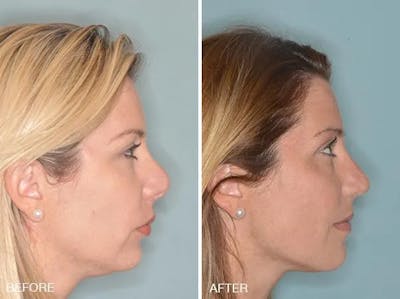 Revision Rhinoplasty before and after, lateral right.