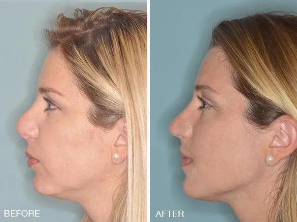 Revision Rhinoplasty before and after, lateral left.