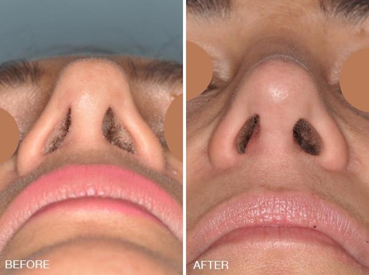 Revision Rhinoplasty before and after, frontal.