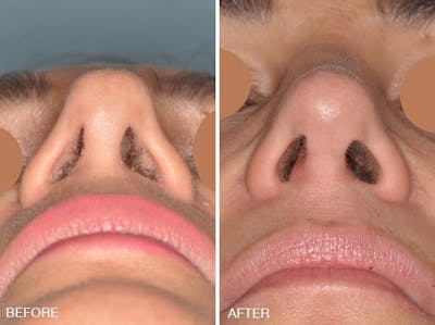 Revision Rhinoplasty before and after, frontal.