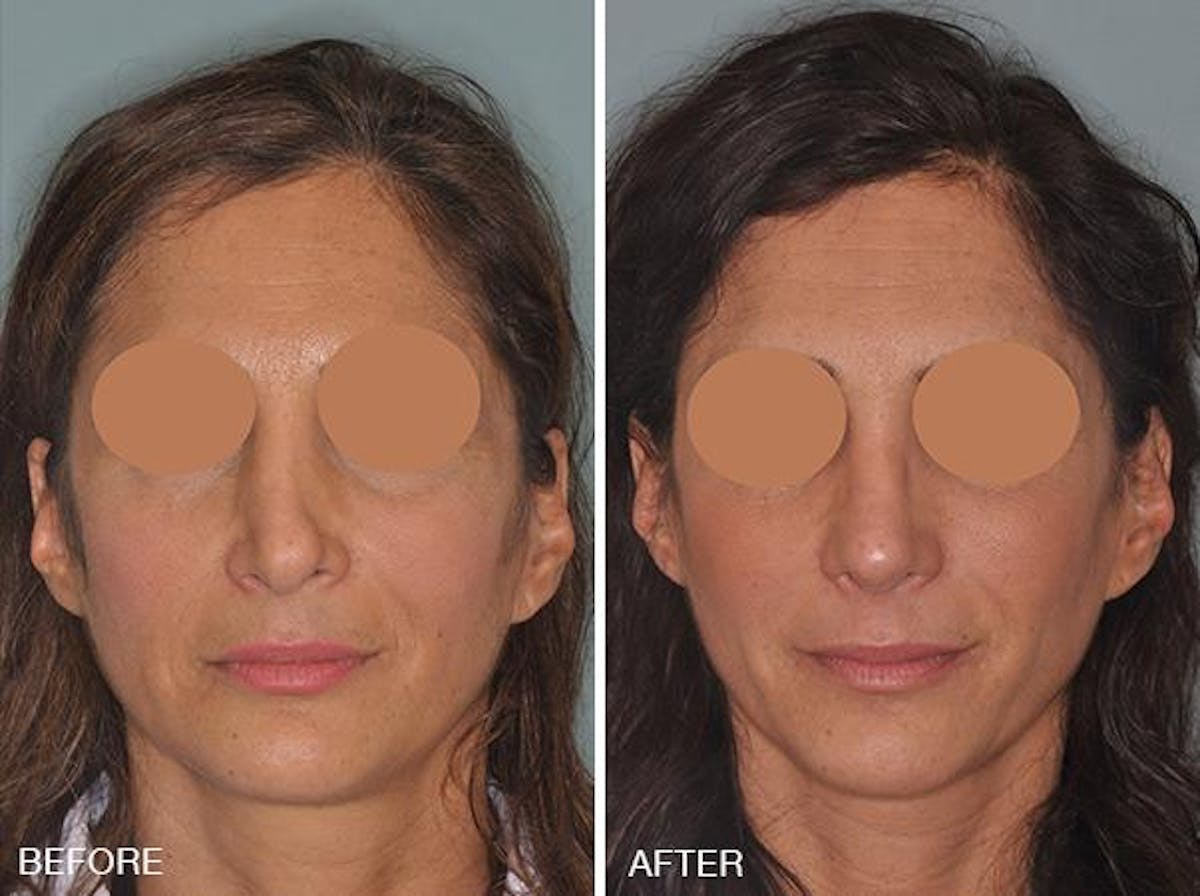 Revision Rhinoplasty before and after, frontal.