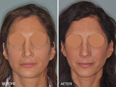Revision Rhinoplasty before and after, frontal.