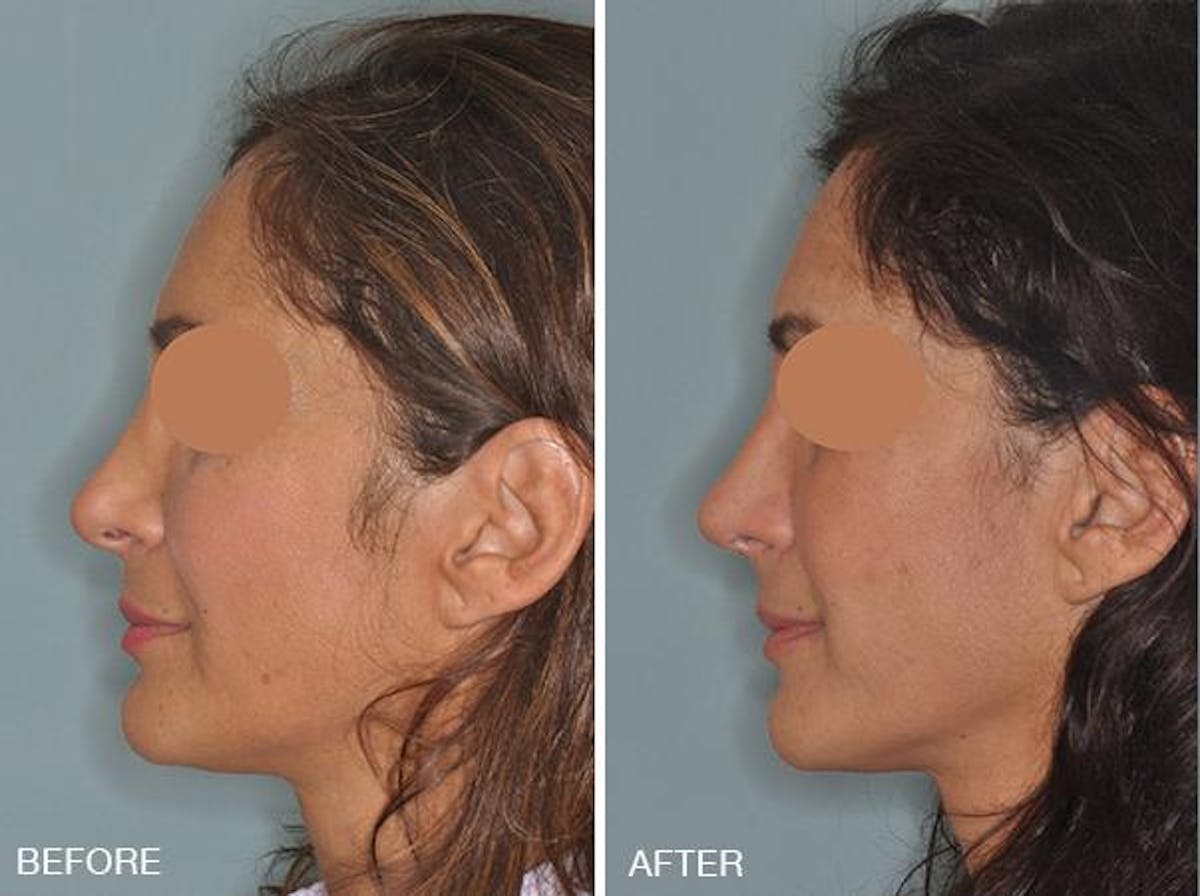 Revision Rhinoplasty before and after, lateral left.