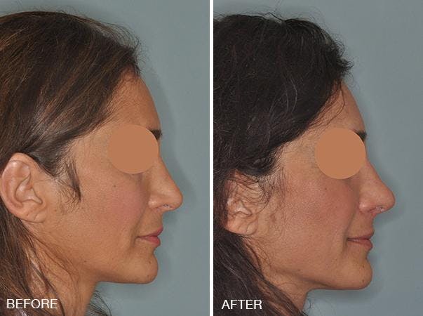 Revision Rhinoplasty before and after, lateral right.