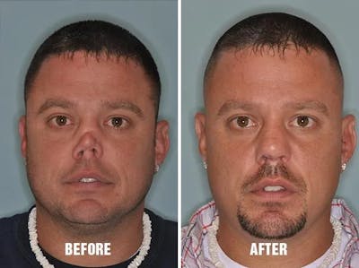 Revision Rhinoplasty before and after, frontal.