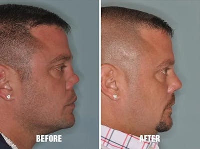 Revision Rhinoplasty before and after, lateral right.