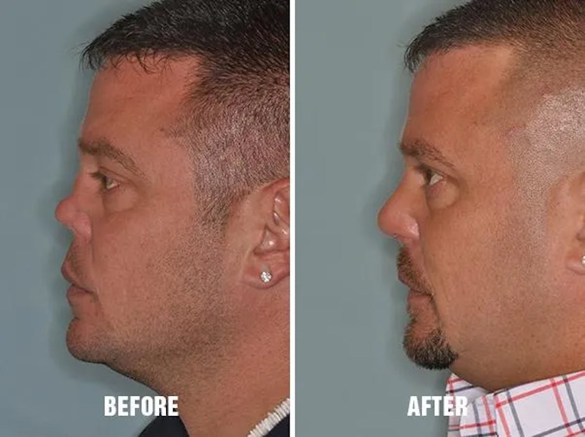 Revision Rhinoplasty before and after, lateral left.