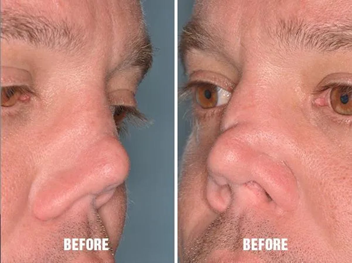 Revision Rhinoplasty before and after, oblique right.