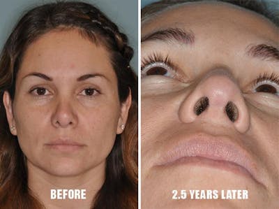 Revision Rhinoplasty before and after, frontal.