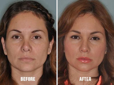 Revision Rhinoplasty before and after, frontal.