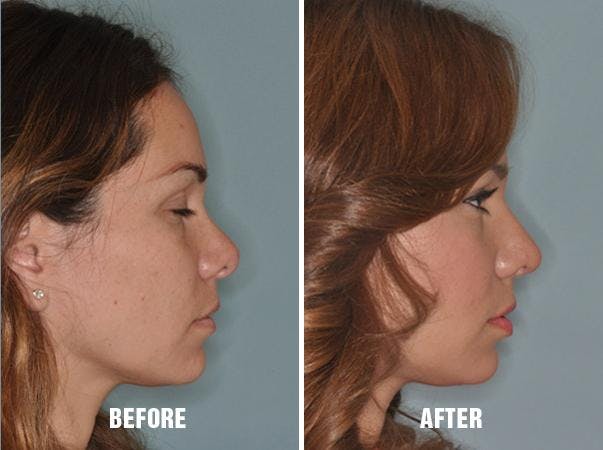 Revision Rhinoplasty before and after, lateral right.