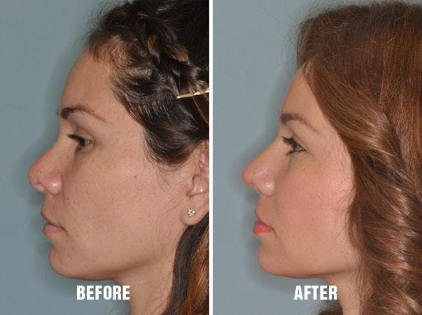 Revision Rhinoplasty before and after, lateral left.