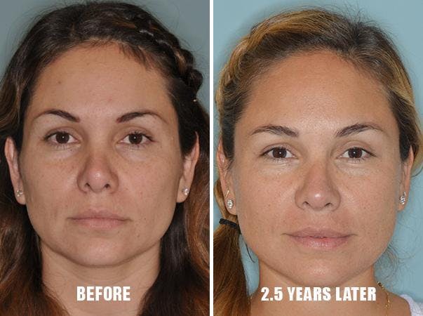 Revision Rhinoplasty before and after, frontal.