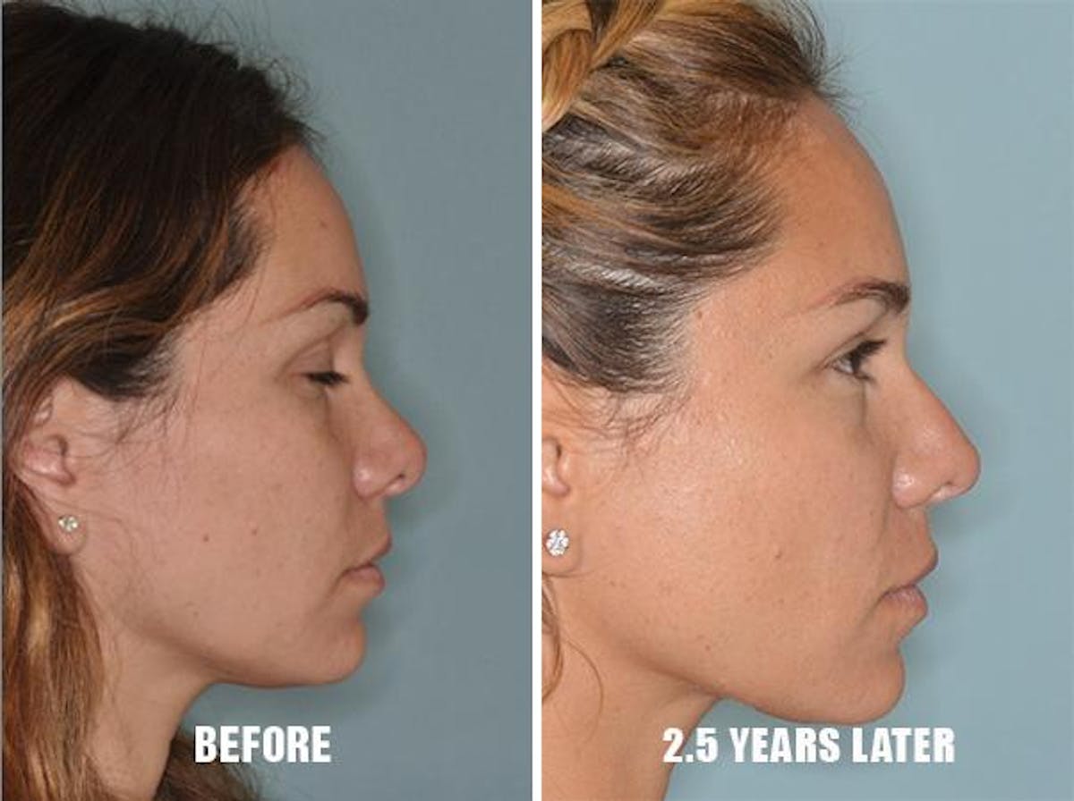 Revision Rhinoplasty before and after, lateral right.