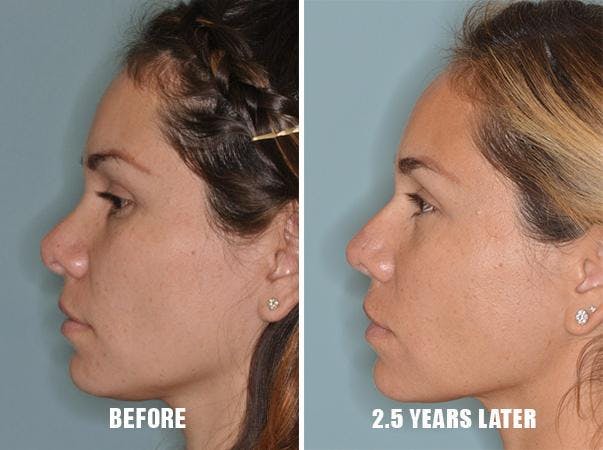 Revision Rhinoplasty before and after, lateral left.