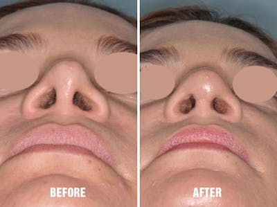 Revision Rhinoplasty before and after, frontal.