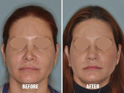 Revision Rhinoplasty before and after, frontal.