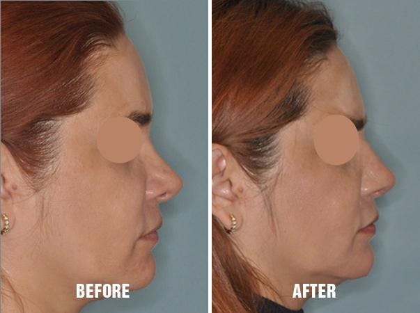 Revision Rhinoplasty before and after, lateral right.