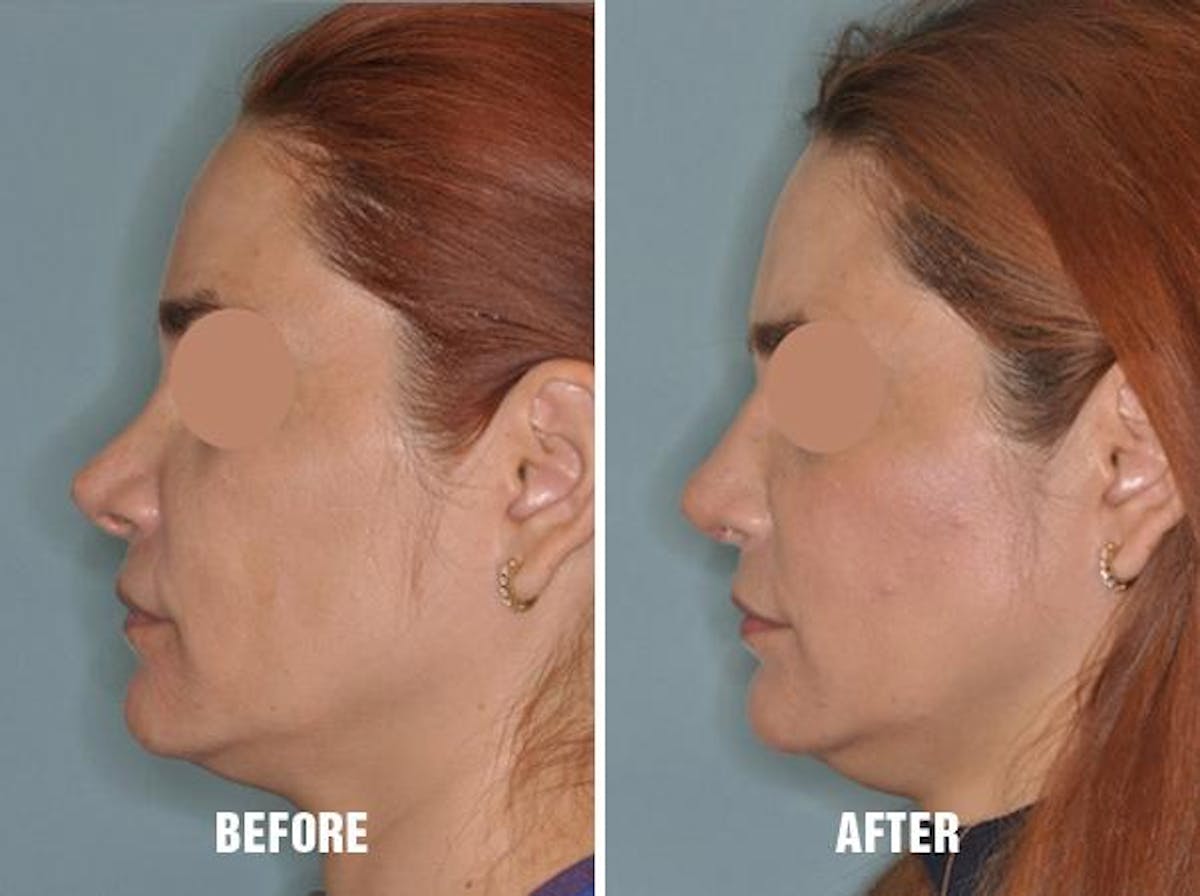 Revision Rhinoplasty before and after, lateral left.